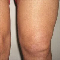 Nautubone za sinovitis